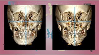 Case 14  Orthognathic surgery  Facial Asymmetry  English [upl. by Initof]