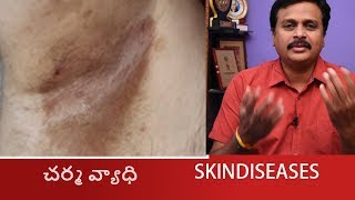 HOW TO SOLVE ERYTHRASMA SKIN DISEASES IN TELUGU CORYNEBACTERIUMHOMEOPATHIC TREATMENT WAKEUP [upl. by Felita]