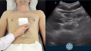 How to scan the abdominal aorta to assess for a potential AAA [upl. by Avonasac34]