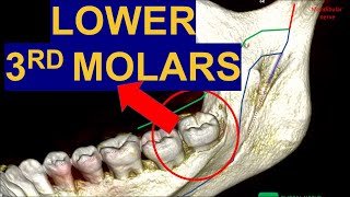 Secrets of Impacted Lower Third Molars CBCT Surgical extraction of wisdom teeth removal surgery [upl. by Lytsirhc]