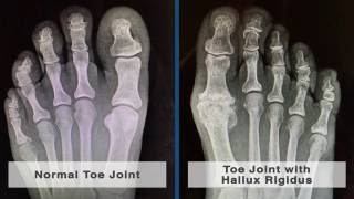 Causes and Treatment of Pain in the Big Toe Joint [upl. by Serica]