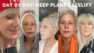 Day by Day Deep Plane Facelift Recovery [upl. by Hoffman]