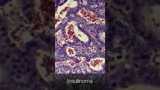 Insulinoma  Pathology shorts [upl. by Eph22]