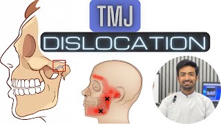 TMJ Dislocation and Management [upl. by Luing]