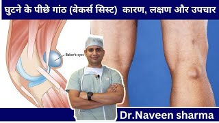 Knee swelling in back of knee  backer cyst treatment what is knee swelling [upl. by Jacqueline]