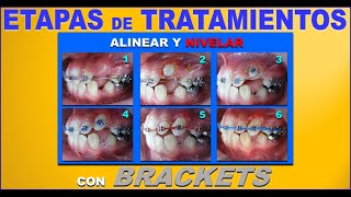 FASES O ETAPAS DE LOS TRATAMIENTOS DE ORTODONCIA CON BRACKETS [upl. by Bettine]