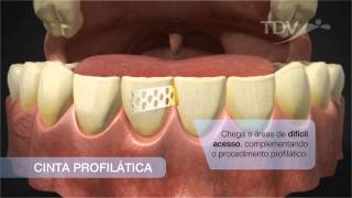 Cinta Profilática TDV  Remoção de tártaro [upl. by Nilyam]