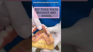 Fixed teeth with Dental Implants In 3 Days 🦷 [upl. by Frohman491]