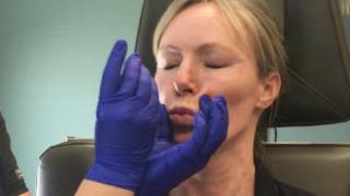 Botox in the neck for a smoother tighter look [upl. by Gagnon724]