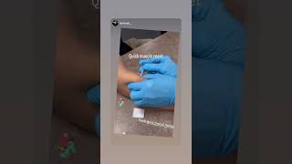 Treatment of elbow paintennis elbow using dry needling [upl. by Nwahsel368]