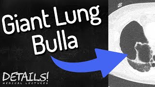 Giant Lung Bulla  Radiology [upl. by Oijimer]