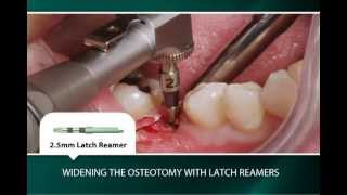 TwoStage Surgical Technique Placement in the Mandibular Right First Molar [upl. by Yrogerg]