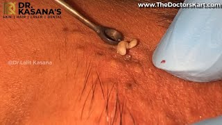 Blackheads Removal New Video by DrLalit Kasana [upl. by Annaerdna]