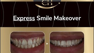 Our Treatment PackagesExpress Smile Makeover 😁 [upl. by Iroc]