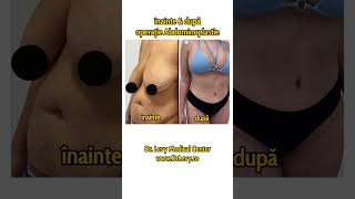 Înainte și după operație de Abdominoplastie  exces de piele abdomen  La Doctor Levy România [upl. by Ahsiuqram599]