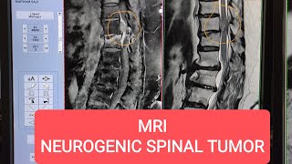 Intradural Extramedullary Neurogenic Spinal Tumor  Neurofibroma  MRI Lumbar Spine with Contrast [upl. by Rudd]