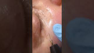 FIBROBLAST  SKIN TIGHTENING lower eyelids [upl. by Helena926]