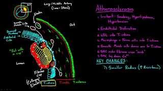 Atherosclerosis  Part 2 [upl. by Nylatsyrc]