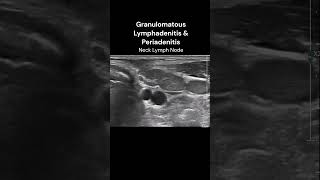 Neck Lymph Nodes  4 ultrasound imaging infection inflammation cases [upl. by Etnaihc649]