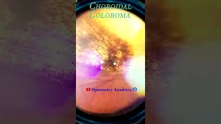 Choroidal Coloboma  Myopic degeneration  Fundus Photography  Short Video 69 [upl. by Boardman]