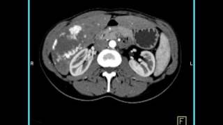 Abdomen Liver Cavernous Hemangioma of the Liver1 of 9 [upl. by Verdi62]