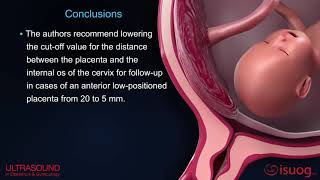 New UOG video abstract on placenta previa and low‐lying placenta second trimester ultrasound [upl. by Adanama]