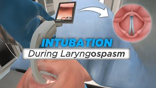 Intubation during Laryngospasm [upl. by Loats]