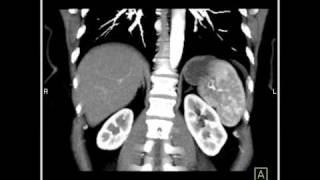 Abdomen Liver Hemangioma of the Liver3 of 8 [upl. by Ahtiek]