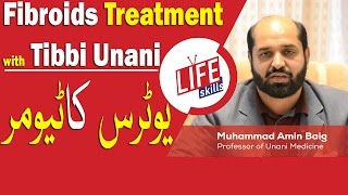 Fibroids Treatment with Tibbi Unani in UrduHindi  Life Skills TV [upl. by Netsriik]