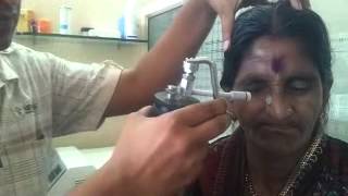 Cryosurgery on Basal cell Carcinoma by Dr Bhutada [upl. by Yroggerg680]