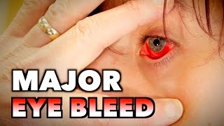 MAJOR EYE BLEED  Possible Mono Spleen Exam amp Blood Draw  Dr Paul [upl. by Lehrer]