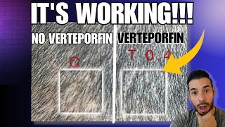 Verteporfin Potential Hair Loss Cure Human Clinical Trial Update ITS WORKING [upl. by Sou]