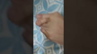 Hallux valgus  Rheumatoid Arthritis patient clinicalexaminationhospital medicalexamination [upl. by Acir]