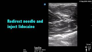 Ultrasound Guided Median Nerve Block Procedure [upl. by Anim]