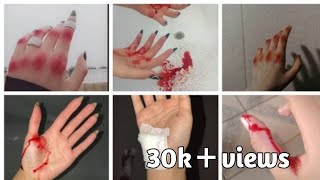 🫣😂🤕 Accident dp ideas 2023  hand bandage dp for girls  hand cut dpz  cannula hand dp photo [upl. by Akeihsal]