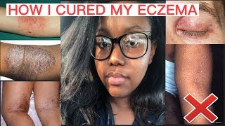 HOW I CURED MY ECZEMA FOREVER [upl. by Ellednahs]