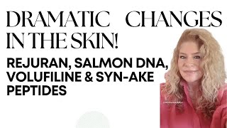 Skincare Revolution Achieve Stunning Results with Rejuran Volufiline amp Synake Peptides [upl. by Bounds]