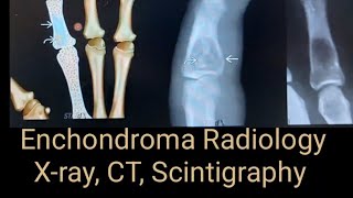 Enchondroma Radiology x ray CT and Scintigraphy Study points [upl. by Dachia]