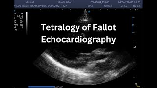 Tetralogy of Fallot  Point of Care ECHO  Short Video [upl. by Novaelc927]