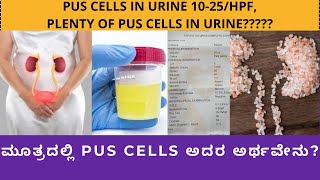 PUS CELLS IN URINE PUS CELLS PLENTY CAUSES SYMPTOMS TREATMENT AND HOME REMEDIES [upl. by Alihs119]