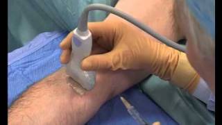 Median Nerve Block Ultrasound guided [upl. by Hermia]