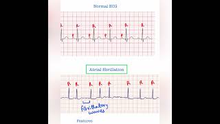 Atrial fibrillation ECG  USMLE Step 1 amp 2 [upl. by Etat218]