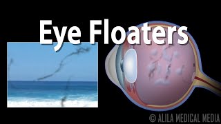 Eye Floaters and Flashes Animation [upl. by Acirat483]