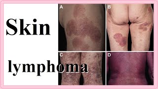 skin lymphoma [upl. by Imled509]