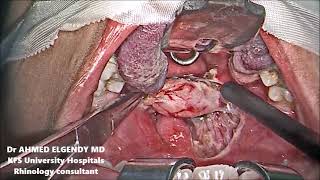 Secondary post tonsillectomy bleeding haemorrhage Part 1  Theories Facts and Fallacies [upl. by Einafit801]