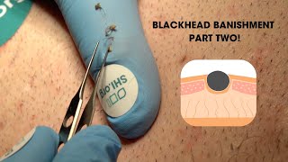 Blackhead Banishment Part Two Super Satisfying Blackhead Squeeze [upl. by Gunar]