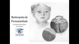 Retina e VÃ­treo 01122022  Retinopatia da Prematuridade [upl. by Eberhart442]