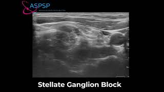 Stellate Ganglion Block for COVID Tongue [upl. by Yevreh]