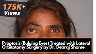 Proptosis Bulging Eyes Treated with Lateral Orbitotomy Surgery by Dr Debraj Shome [upl. by Syst]