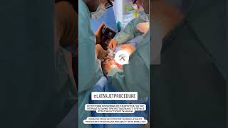 Osteotomizing the Coracoid Process during Latarjet Procedure shoulderinstability [upl. by Ledeen808]